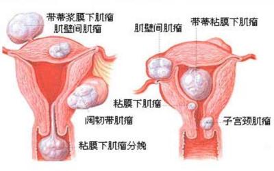 子宫肌.jpg